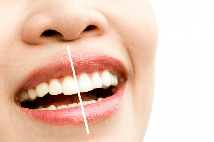 /treatments/teeth-whitening/