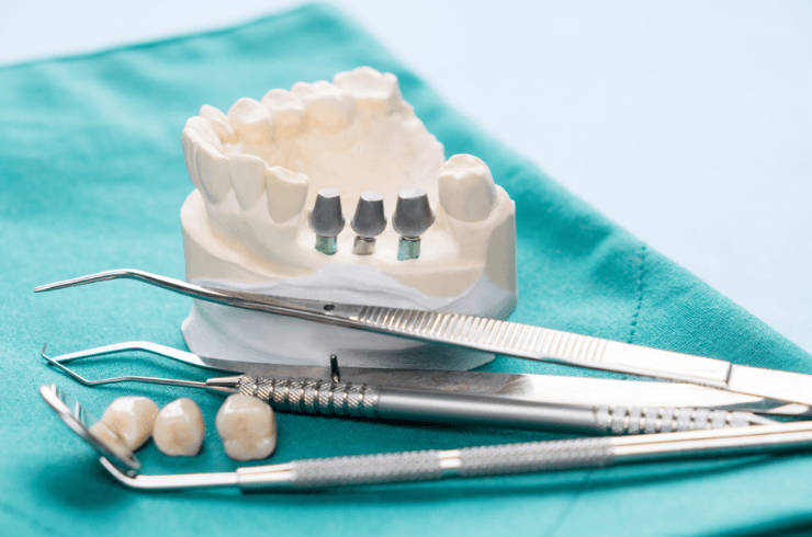 Dental Crowns & Bridges